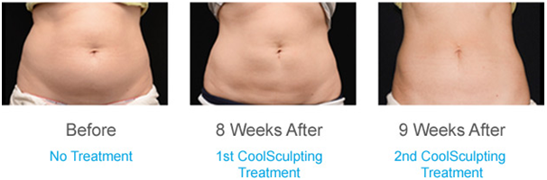 coolsculpting